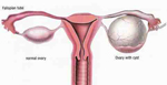 Ovarian Cysts 
